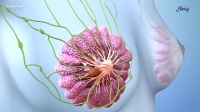 Mueren 12 mujeres al d&iacute;a por c&aacute;ncer de mama en M&eacute;xico